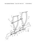 Apparatus for Osteotomy and Graft Preparation diagram and image