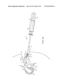 Insertion Handle For Surgical Implants diagram and image