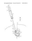 Insertion Handle For Surgical Implants diagram and image