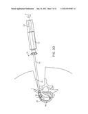 Insertion Handle For Surgical Implants diagram and image
