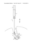 Insertion Handle For Surgical Implants diagram and image