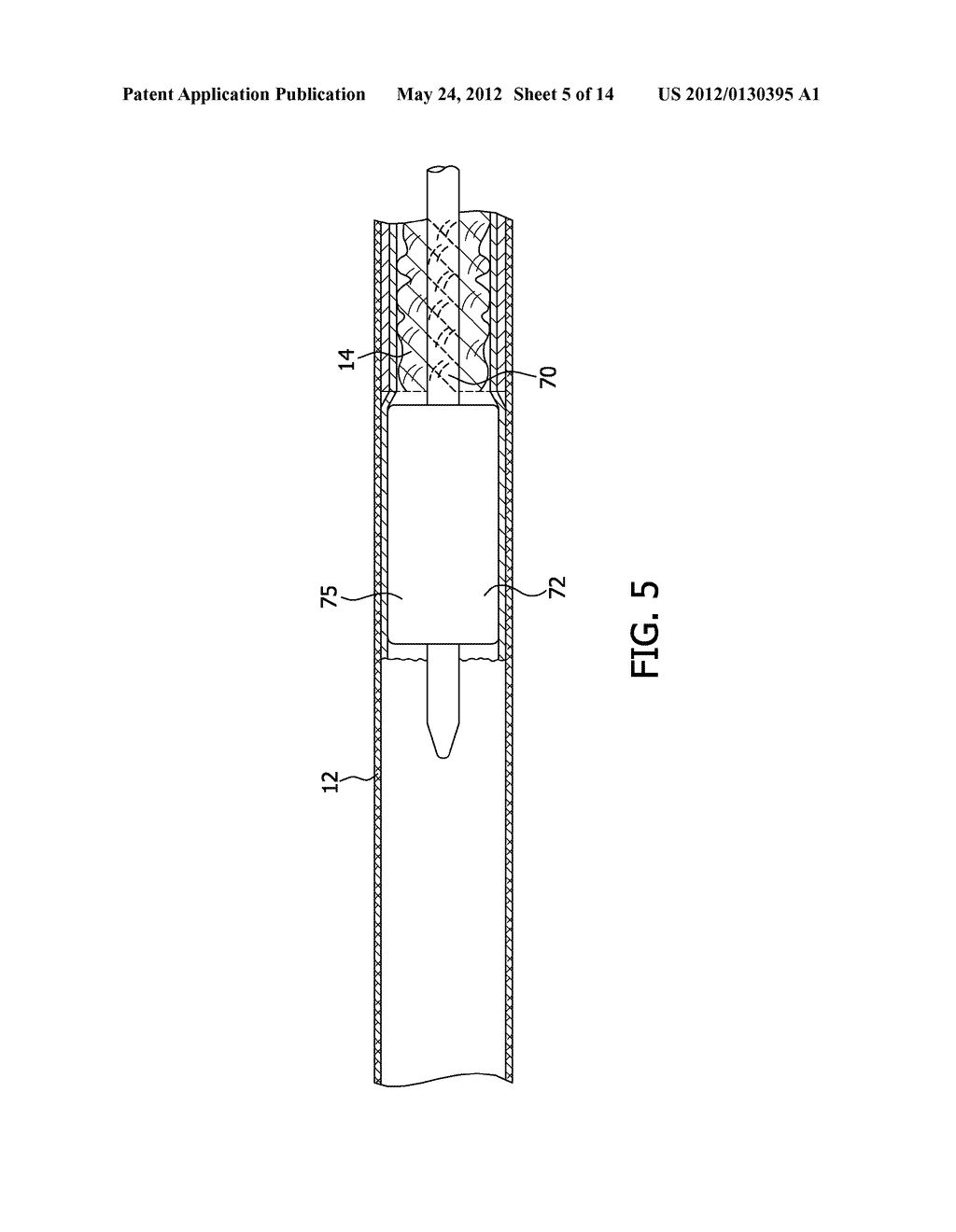 PERCUTANEOUS THROMBUS EXTRACTION DEVICE AND METHOD - diagram, schematic, and image 06