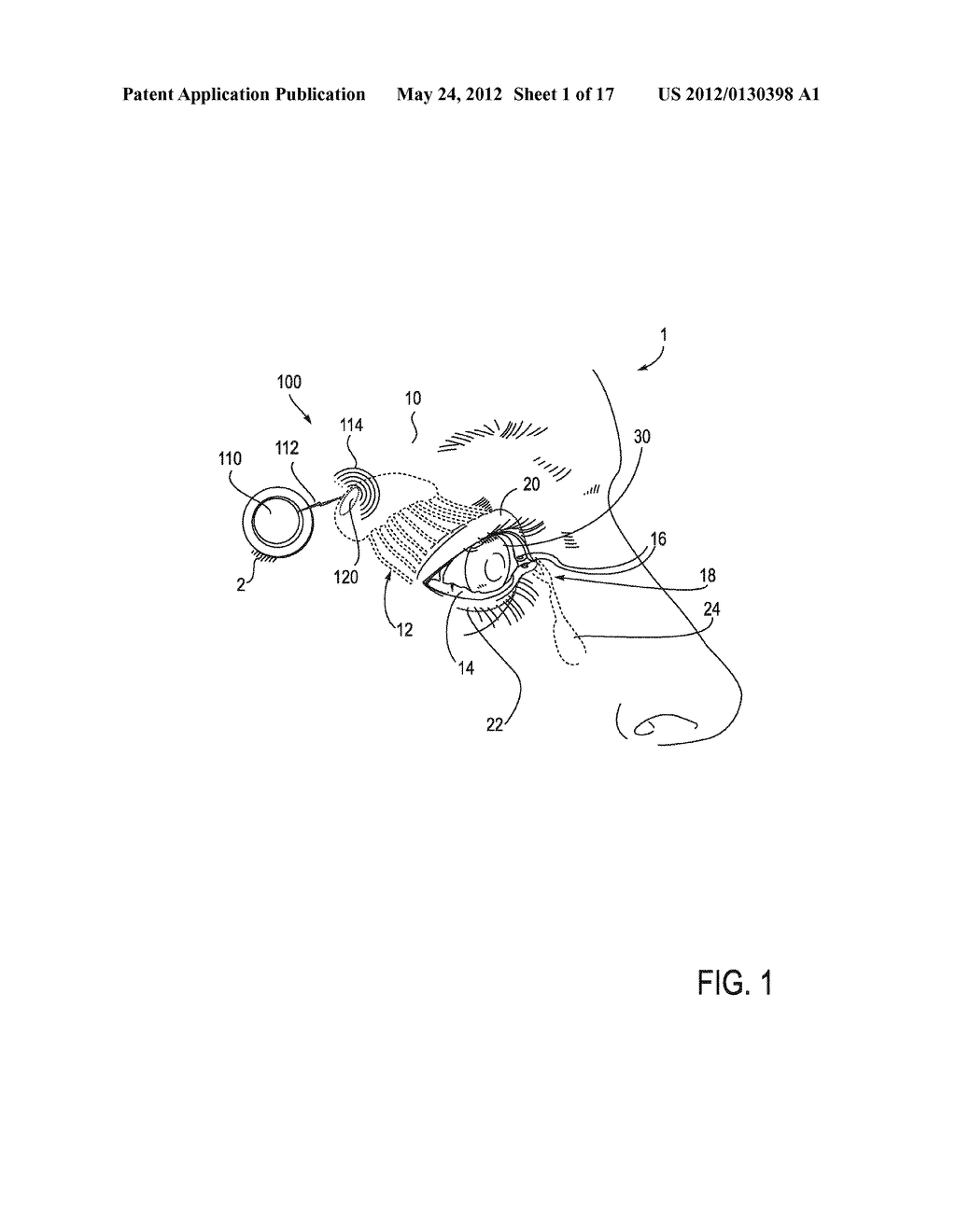 SYSTEMS AND METHODS FOR TREATMENT OF DRY EYE - diagram, schematic, and image 02