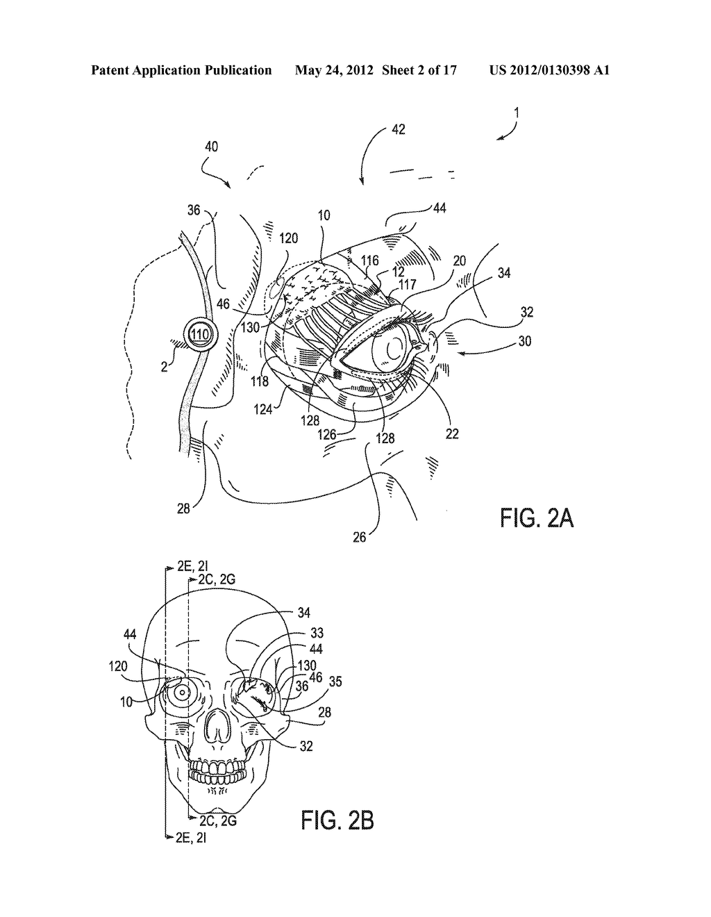 SYSTEMS AND METHODS FOR TREATMENT OF DRY EYE - diagram, schematic, and image 03