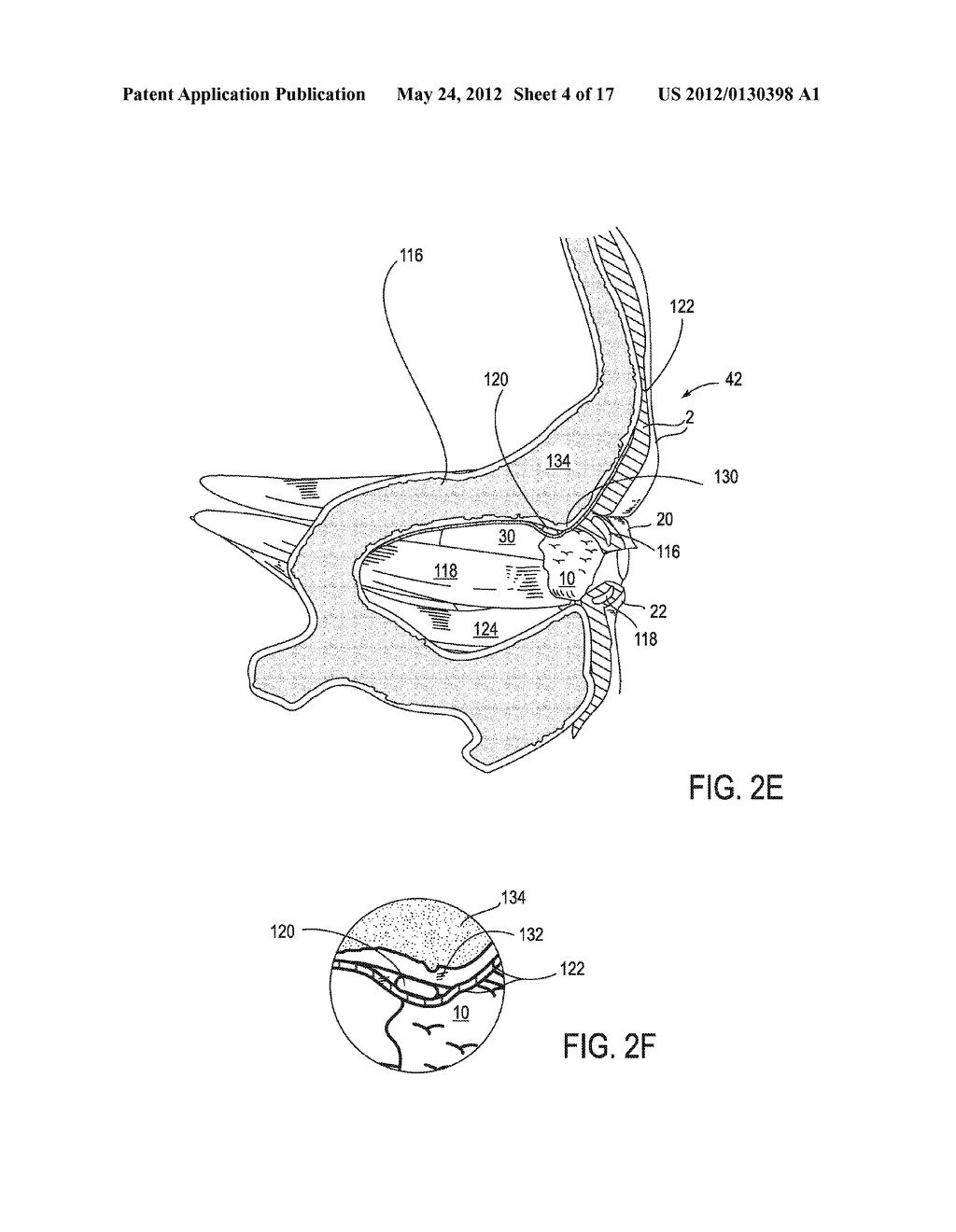 SYSTEMS AND METHODS FOR TREATMENT OF DRY EYE - diagram, schematic, and image 05