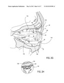 SYSTEMS AND METHODS FOR TREATMENT OF DRY EYE diagram and image