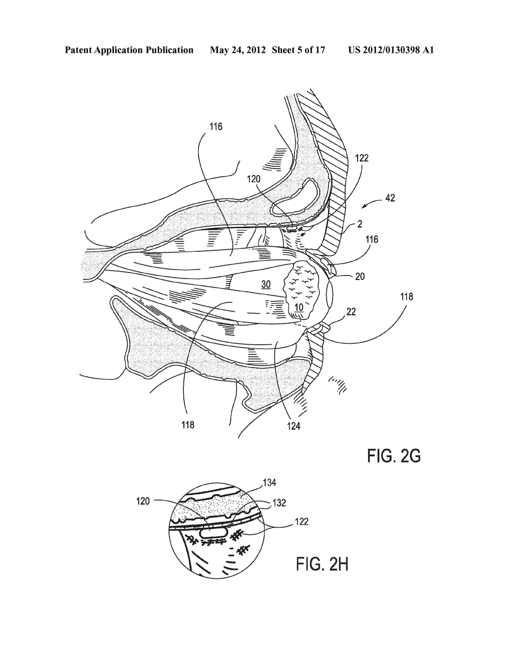 SYSTEMS AND METHODS FOR TREATMENT OF DRY EYE - diagram, schematic, and image 06