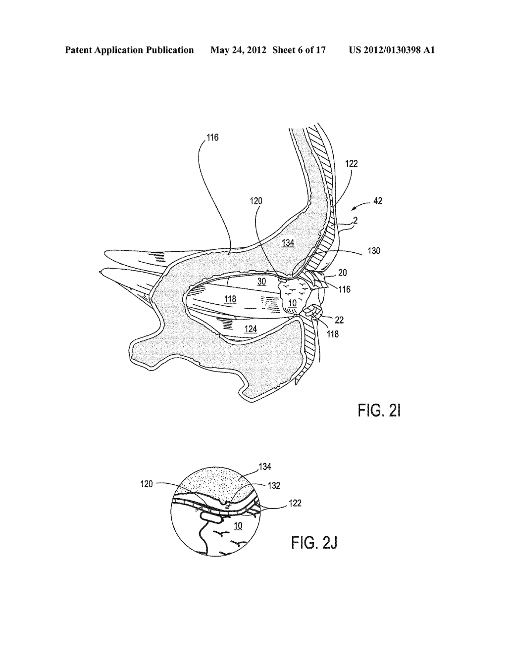 SYSTEMS AND METHODS FOR TREATMENT OF DRY EYE - diagram, schematic, and image 07