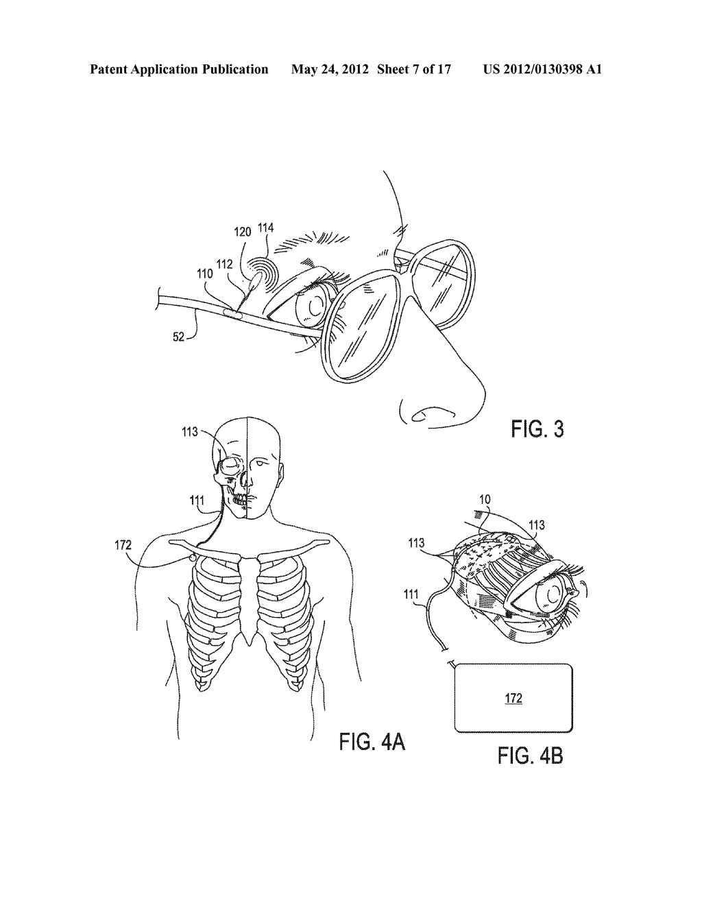SYSTEMS AND METHODS FOR TREATMENT OF DRY EYE - diagram, schematic, and image 08