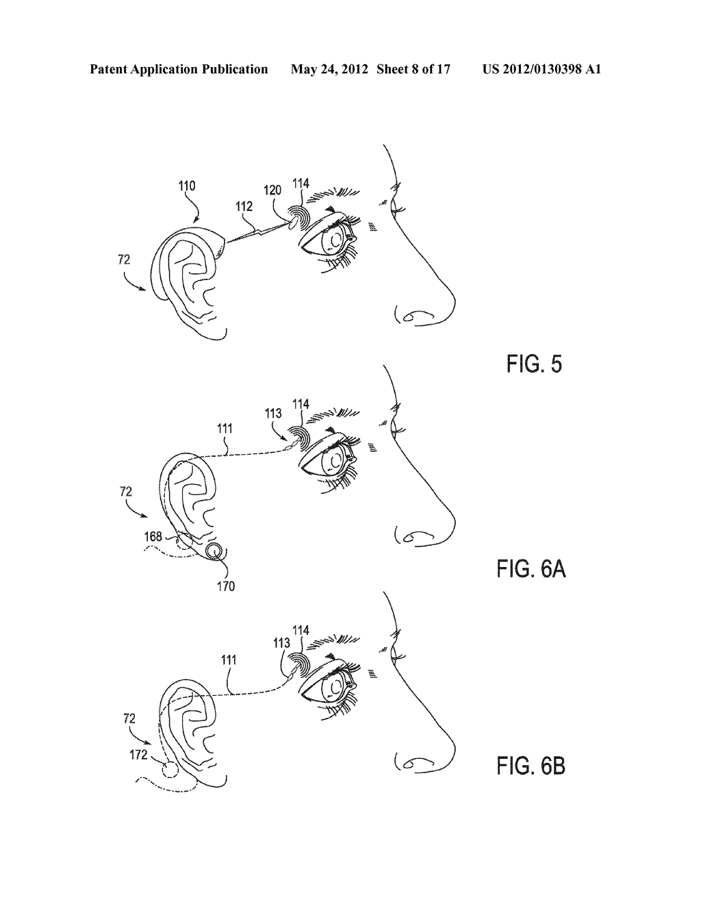 SYSTEMS AND METHODS FOR TREATMENT OF DRY EYE - diagram, schematic, and image 09