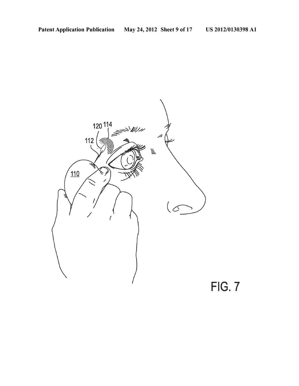 SYSTEMS AND METHODS FOR TREATMENT OF DRY EYE - diagram, schematic, and image 10