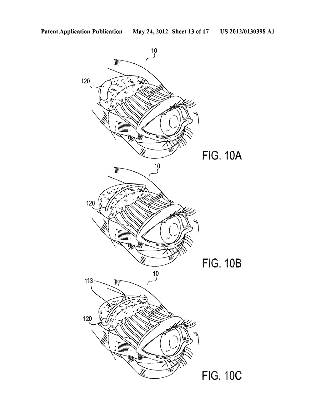 SYSTEMS AND METHODS FOR TREATMENT OF DRY EYE - diagram, schematic, and image 14