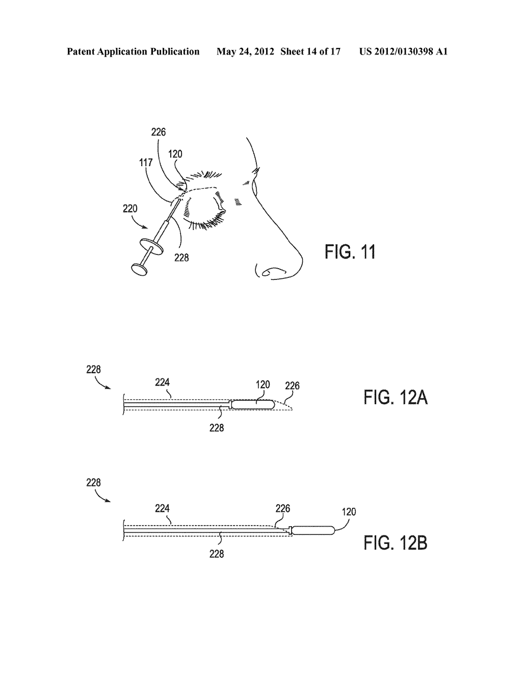 SYSTEMS AND METHODS FOR TREATMENT OF DRY EYE - diagram, schematic, and image 15