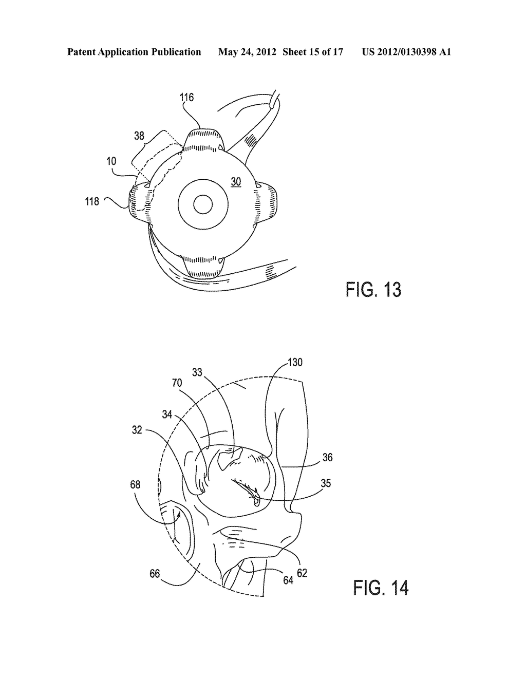 SYSTEMS AND METHODS FOR TREATMENT OF DRY EYE - diagram, schematic, and image 16