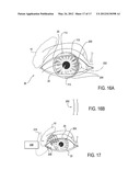 SYSTEMS AND METHODS FOR TREATMENT OF DRY EYE diagram and image