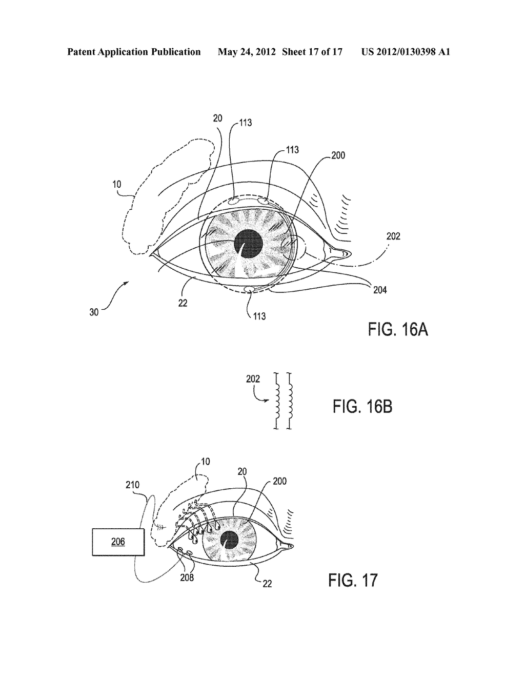 SYSTEMS AND METHODS FOR TREATMENT OF DRY EYE - diagram, schematic, and image 18