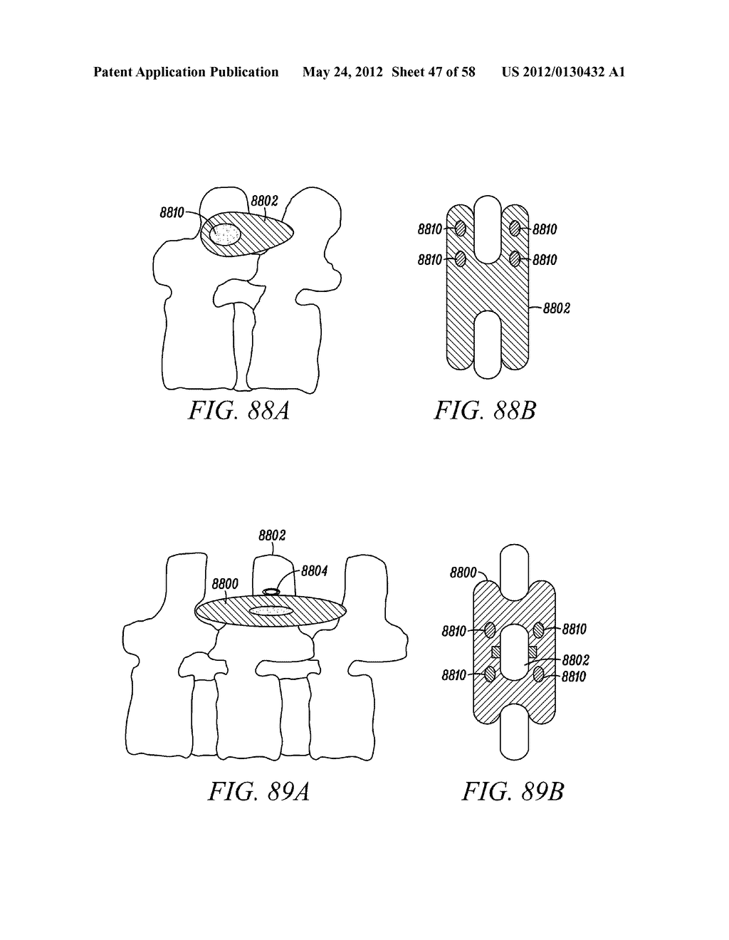 Methods and Apparatus for Treating Spinal Stenosis - diagram, schematic, and image 48