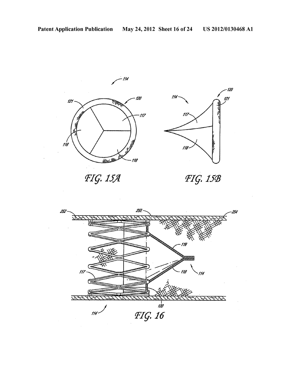 METHODS AND APPARATUS FOR TREATING NEUROVASCULAR VENOUS OUTFLOW     OBSTRUCTION - diagram, schematic, and image 17