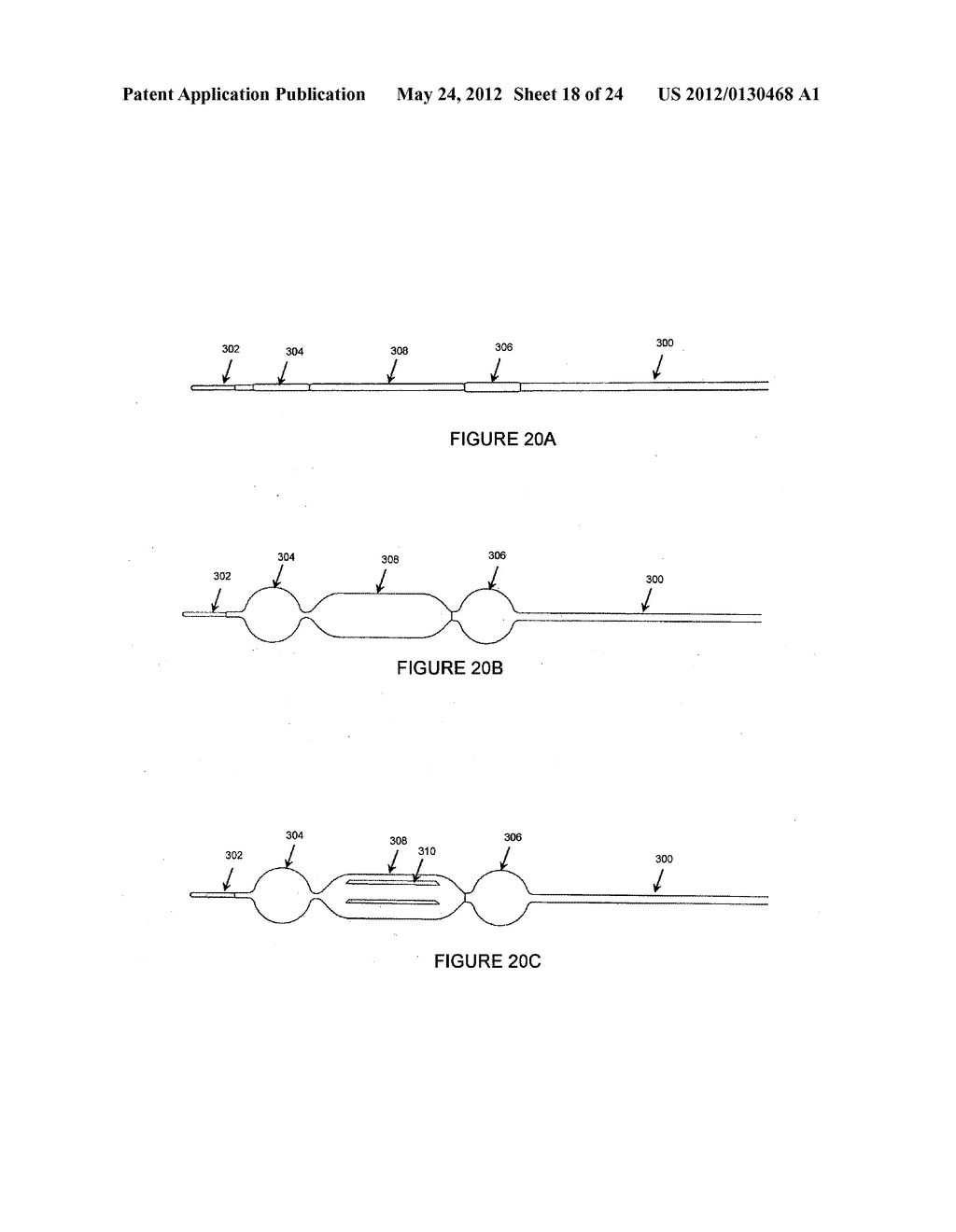 METHODS AND APPARATUS FOR TREATING NEUROVASCULAR VENOUS OUTFLOW     OBSTRUCTION - diagram, schematic, and image 19