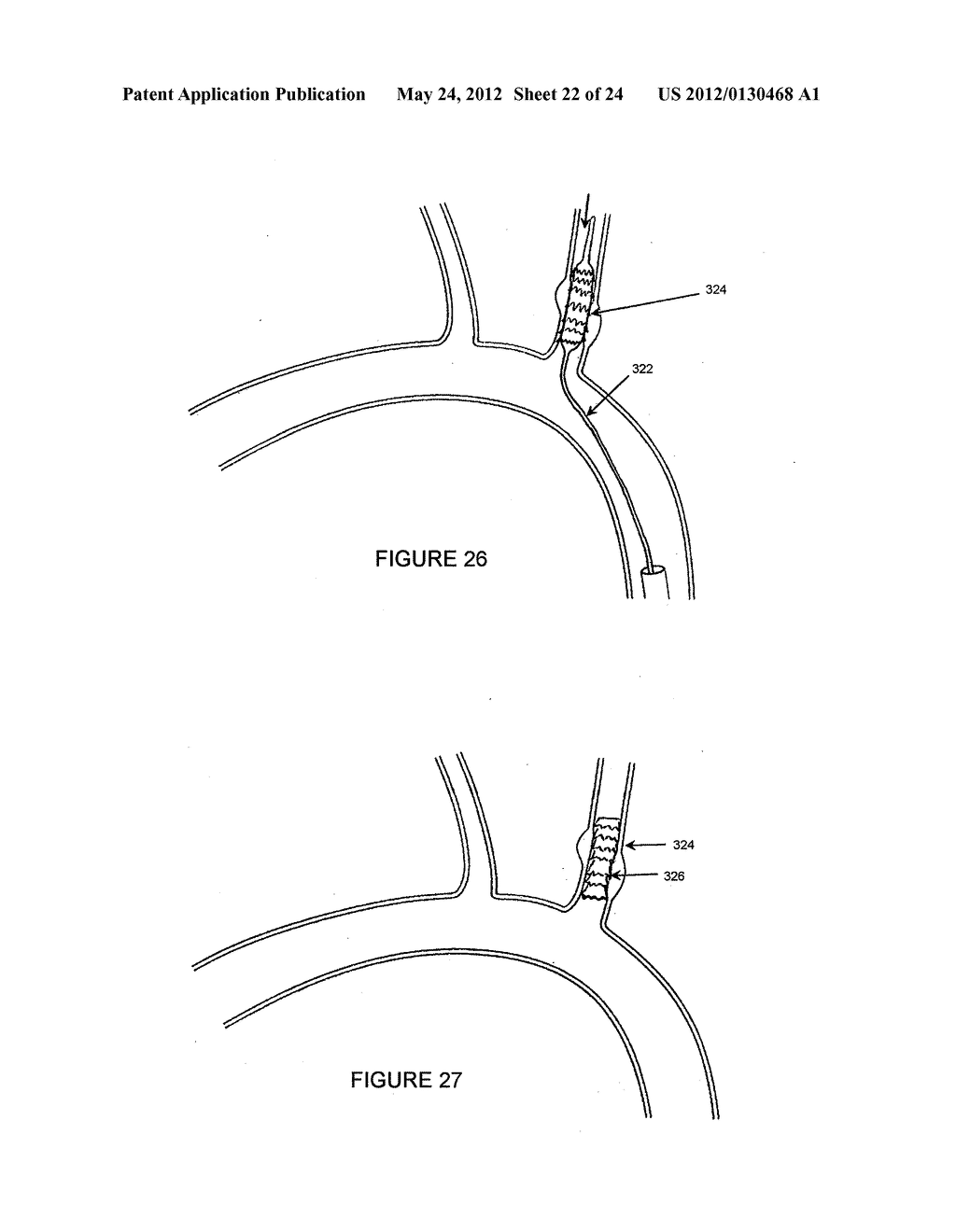 METHODS AND APPARATUS FOR TREATING NEUROVASCULAR VENOUS OUTFLOW     OBSTRUCTION - diagram, schematic, and image 23