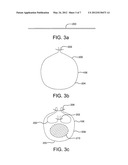 DEPLOYMENT OF ENDOLUMINAL DEVICES diagram and image