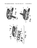 Intervertebral Fusion Implant diagram and image