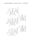 Arthroplasty spinal prosthesis and insertion device diagram and image