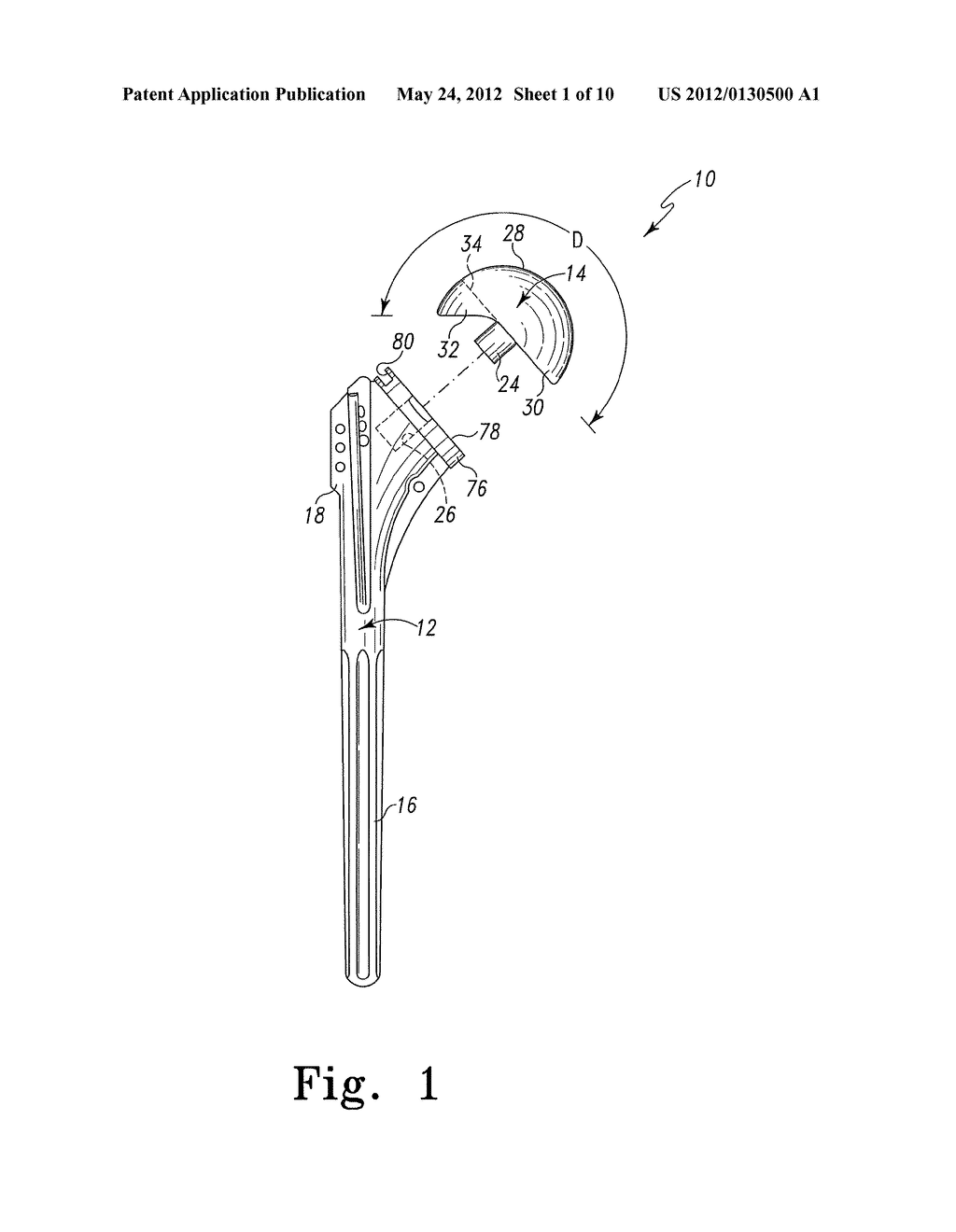 Procedure for the Treatment of Cuff Tear Arthropathy - diagram, schematic, and image 02