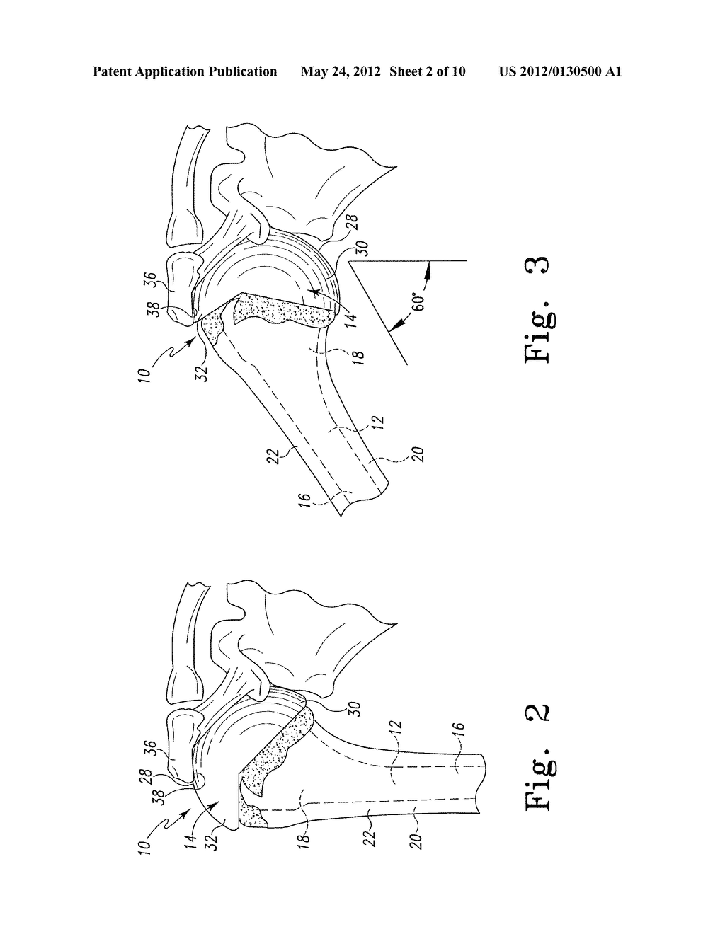 Procedure for the Treatment of Cuff Tear Arthropathy - diagram, schematic, and image 03