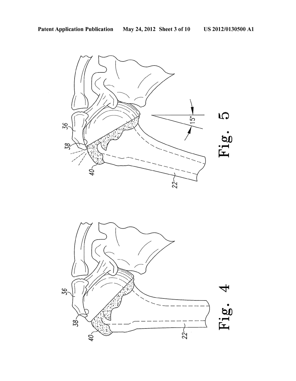 Procedure for the Treatment of Cuff Tear Arthropathy - diagram, schematic, and image 04