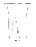 METHOD AND APPARATUS FOR HIP REPLACEMENT diagram and image