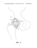 METHOD AND APPARATUS FOR HIP REPLACEMENT diagram and image