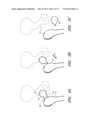 METHOD AND APPARATUS FOR HIP REPLACEMENT diagram and image