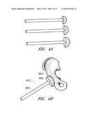 METHOD AND APPARATUS FOR HIP REPLACEMENT diagram and image