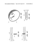 METHOD AND APPARATUS FOR HIP REPLACEMENT diagram and image