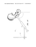 METHOD AND APPARATUS FOR HIP REPLACEMENT diagram and image