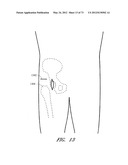 METHOD AND APPARATUS FOR HIP REPLACEMENT diagram and image