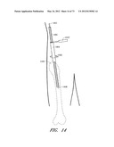 METHOD AND APPARATUS FOR HIP REPLACEMENT diagram and image