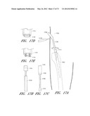 METHOD AND APPARATUS FOR HIP REPLACEMENT diagram and image