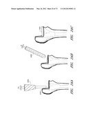 METHOD AND APPARATUS FOR HIP REPLACEMENT diagram and image