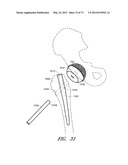 METHOD AND APPARATUS FOR HIP REPLACEMENT diagram and image