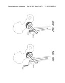 METHOD AND APPARATUS FOR HIP REPLACEMENT diagram and image