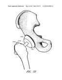 METHOD AND APPARATUS FOR HIP REPLACEMENT diagram and image