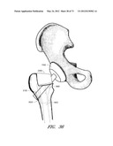 METHOD AND APPARATUS FOR HIP REPLACEMENT diagram and image