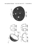 METHOD AND APPARATUS FOR HIP REPLACEMENT diagram and image