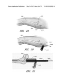 METHOD AND APPARATUS FOR HIP REPLACEMENT diagram and image