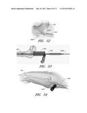 METHOD AND APPARATUS FOR HIP REPLACEMENT diagram and image