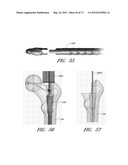 METHOD AND APPARATUS FOR HIP REPLACEMENT diagram and image