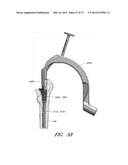 METHOD AND APPARATUS FOR HIP REPLACEMENT diagram and image