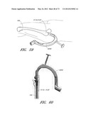 METHOD AND APPARATUS FOR HIP REPLACEMENT diagram and image